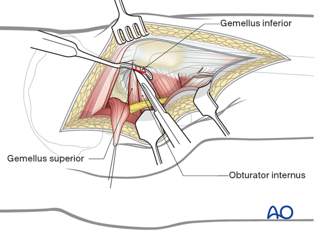 Access to the lesser sciatic notch in a Kocher-Langenbeck approach to the hip