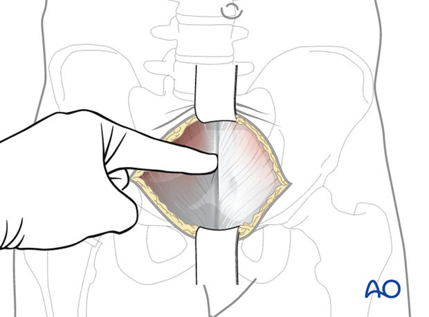 Superficial incision identification in an anterior intrapelvic approach