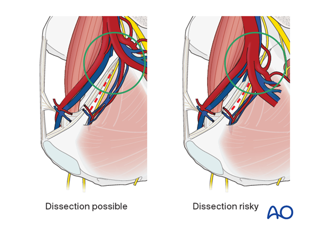 Internal iliac artery bifurcation