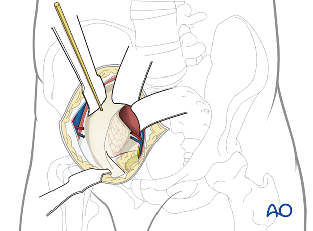 Retractor positioning for quadrilateral surface exposure