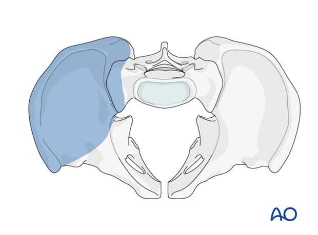 Lateral window exposure in an anterior intrapelvic approach