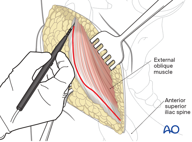 Superficial dissection for ASIS osteotomy