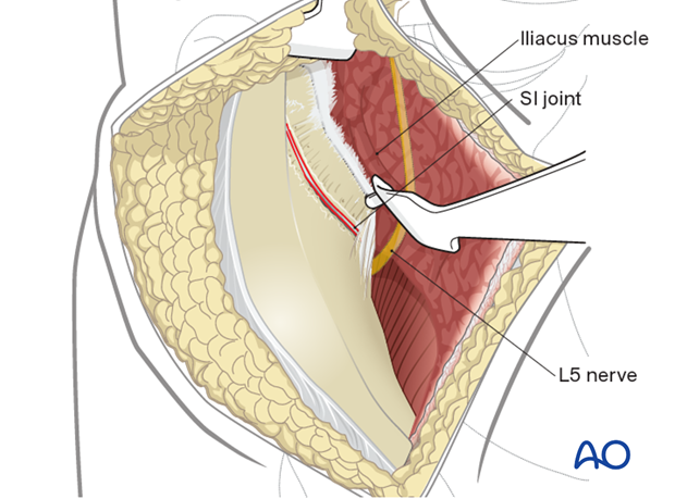 SI joint capsule exposure