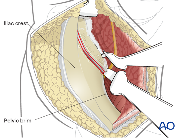 SI joint capsule additional exposure