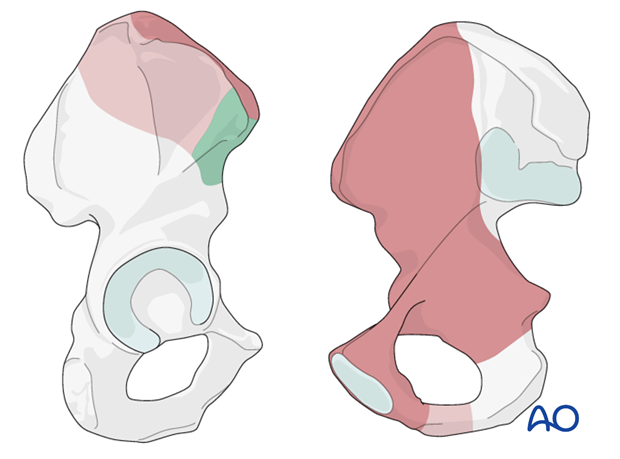 Exposure with an ilioinguinal approach