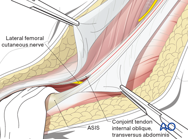 Ilioinguinal approach acetabulum