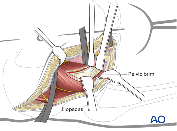 Second window for ilioinguinal approach