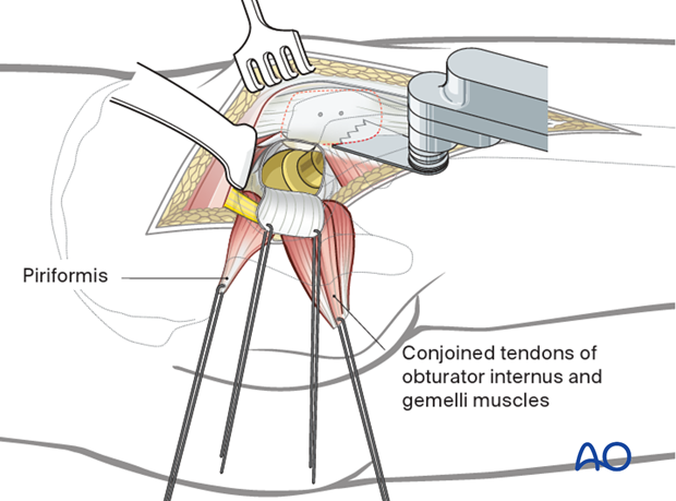 Trochanter osteotomy