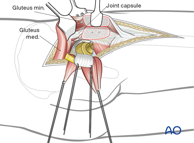 Anterior exposure in a trochanteric osteotomy