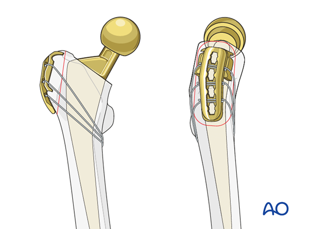 Trochanteric claw following trochanteric osteotomy