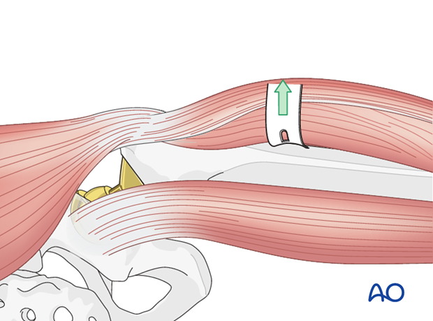 Vastus lateralis elevation