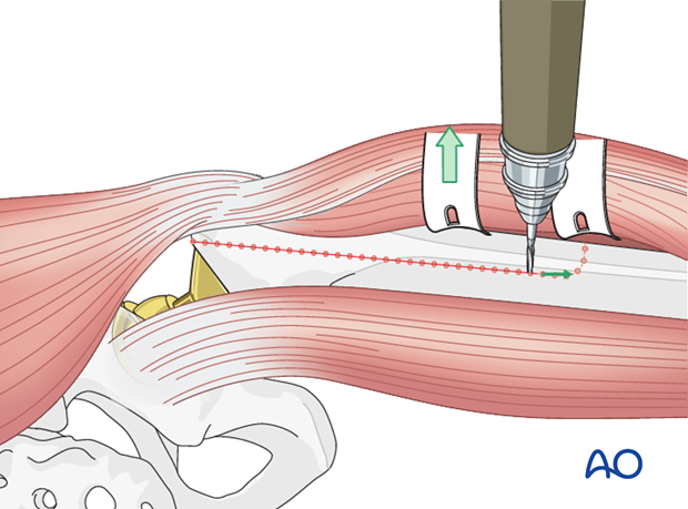 Extended trochanteric osteotomy