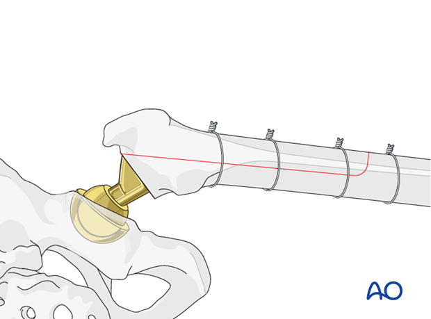 Extended Trochanteric Osteotomy closure