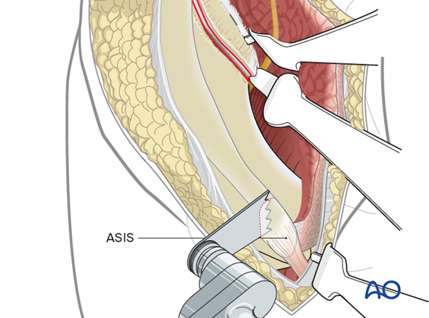 ASIS osteotomy