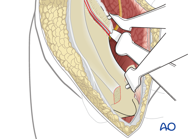 ASIS retraction