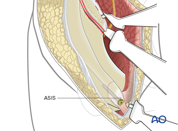 ASIS reattachment