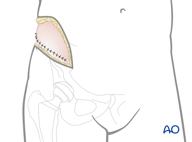 Wound closure after ASIS osteotomy