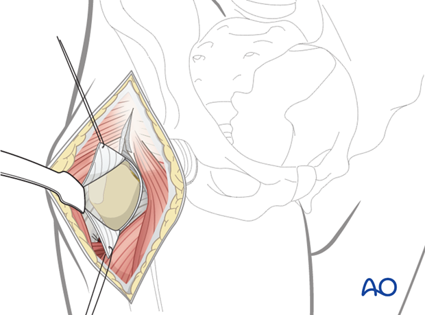 T-shaped capsulotomy