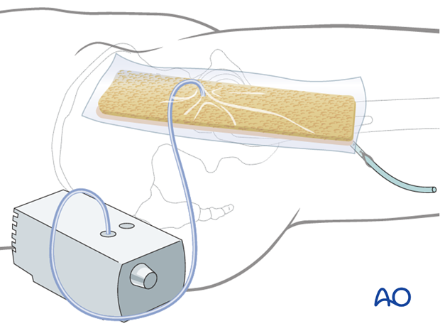 Negative pressure incisional wound care