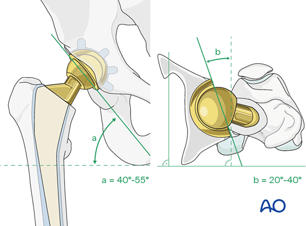 Acetabular cup assessment