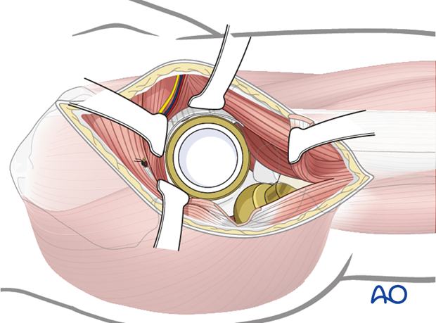 Dislocated hip