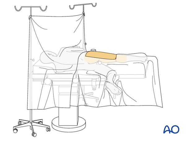 Draping for a patient in lateral decubitus