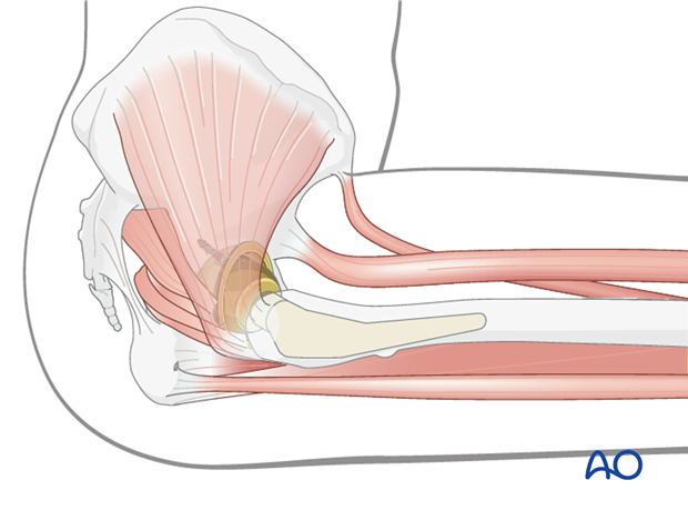 Hip abductor mechanism