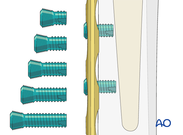 Unicortical locking screw