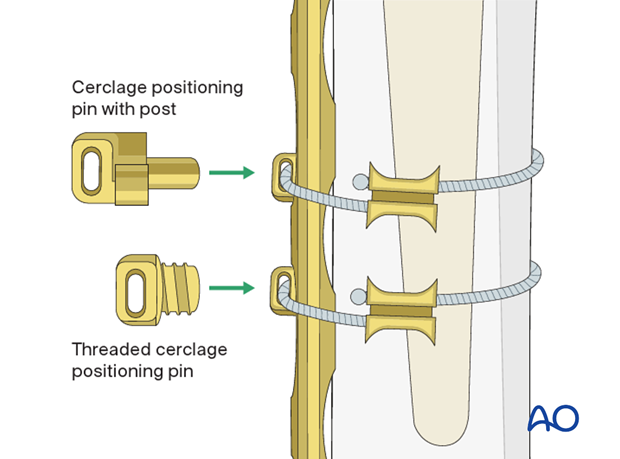 Cerclage positioning pins