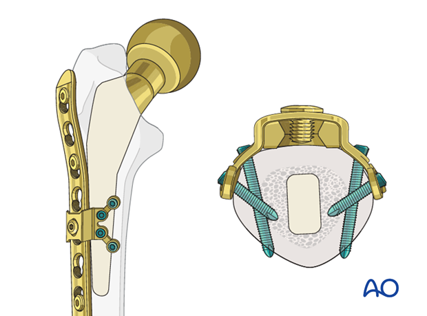 Locking attachment plate