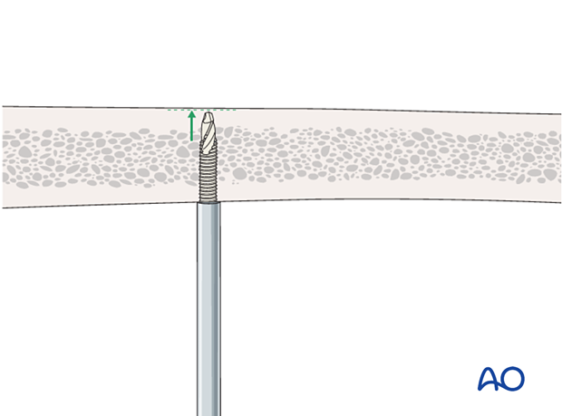 Depth of pin insertion