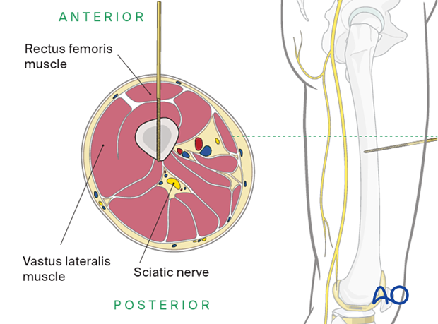 Midshaft of the femur