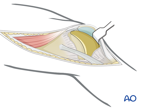 Joint capsule arthrotomy for articular surface visualization