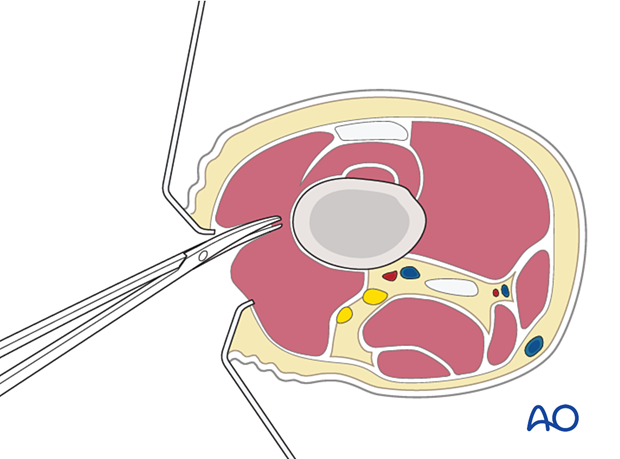 Dissect the muscle fibers apart bluntly down to the femur