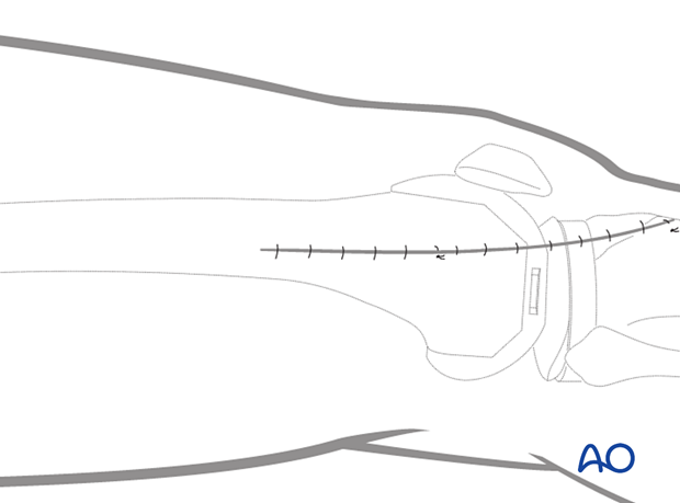 Distal closure