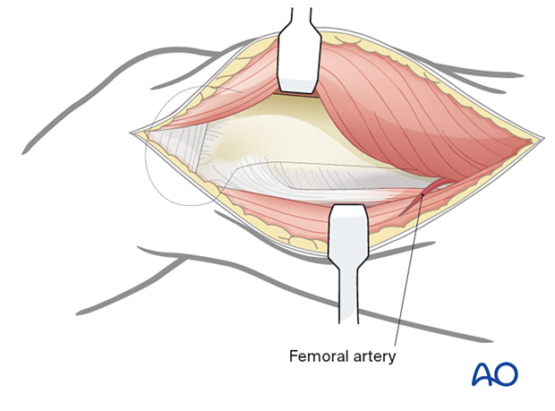 Exposure of the tendon of the adductor magnus