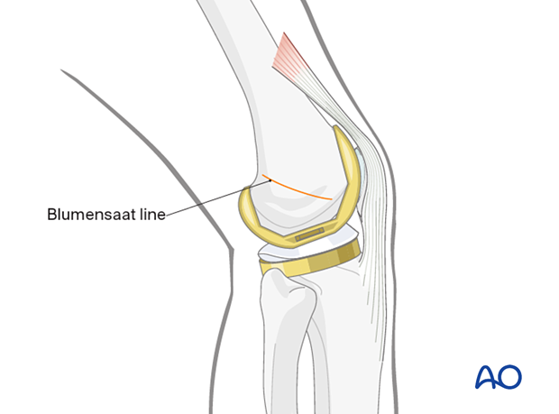 Localization of the entry point