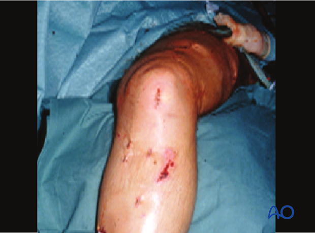 Skin incision