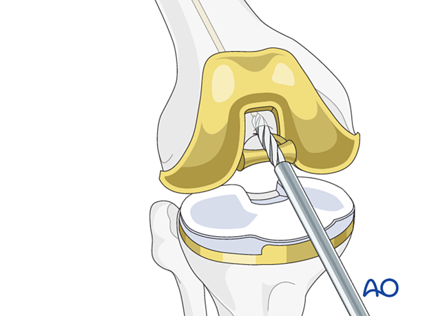 Opening the medullary canal