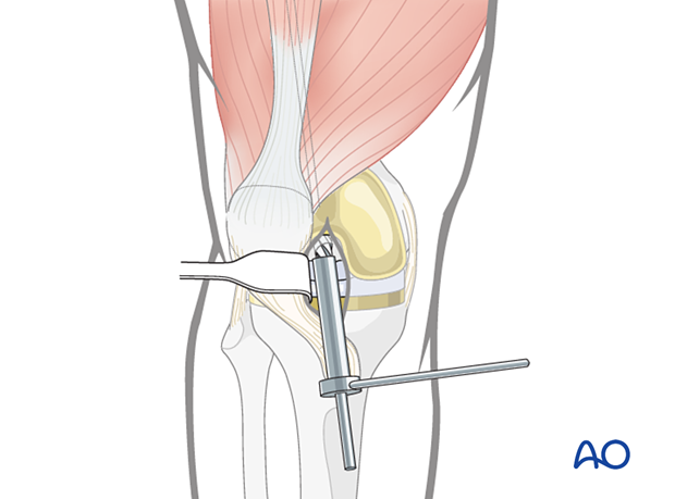 The drill bit, protection sleeve and guide wire are then removed