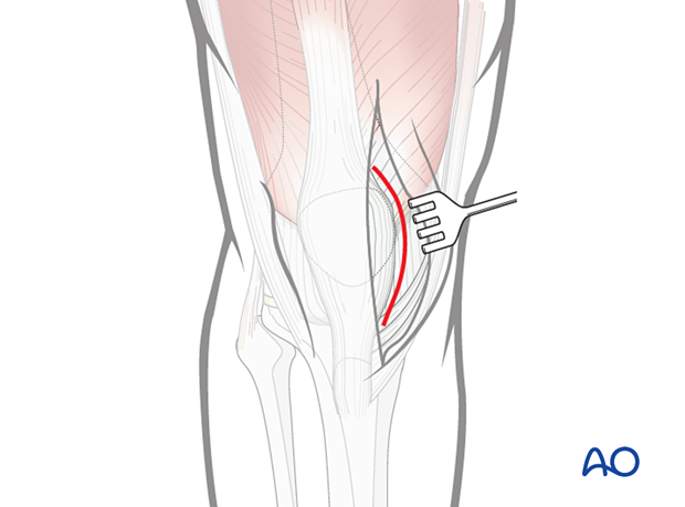 Arthrotomy