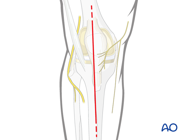 Skin incision