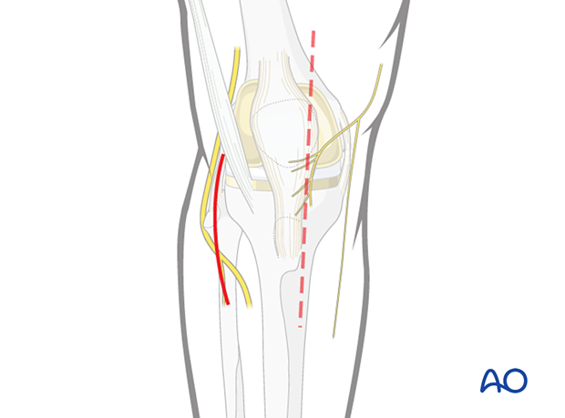 Minimally invasive incision in a more lateral position