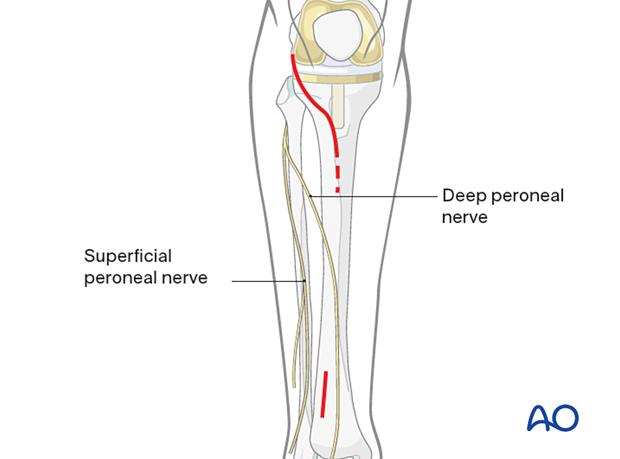 Minimally invasive lateral approach