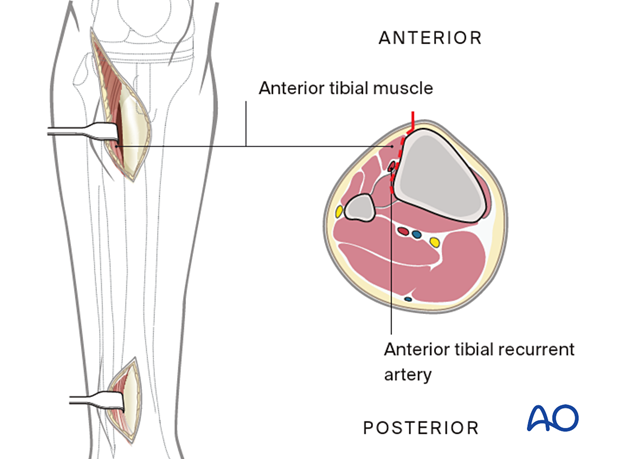 Deep dissection of proximal incision