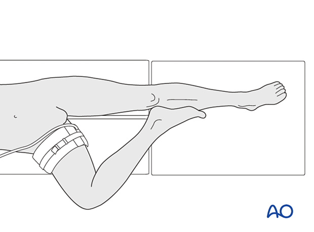 A tourniquet can be considered around the proximal thigh