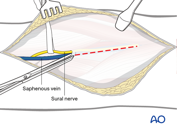 Fascial incision