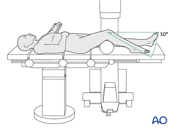 Supine position knee flexed 30 degrees