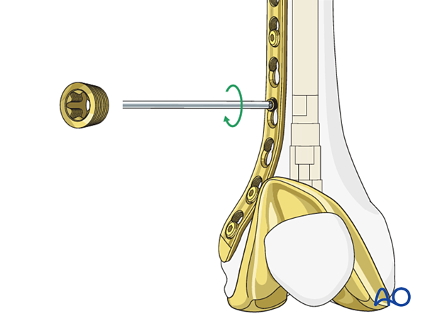 Screw the conical part to the plate