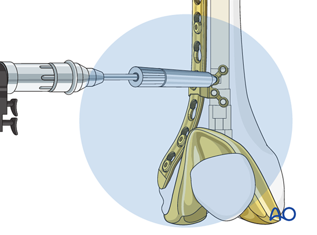 A screw hole is drilled with a drill bit